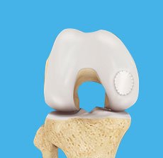 Cartilage Regenerative Surgery