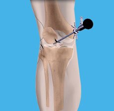 Knee Arthroscopy         