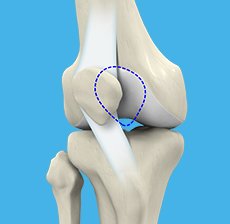 Patela-Femoral Pain and Instability