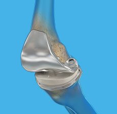 Revision Knee Replacement