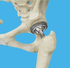 Total Hip Replacement 
