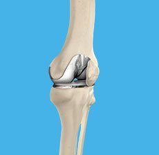 Total Knee Replacement